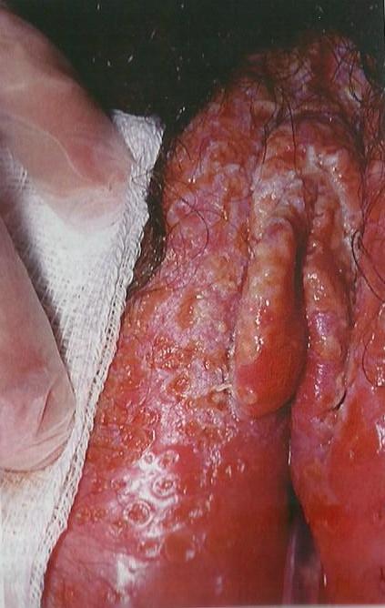 Herpes vulva 