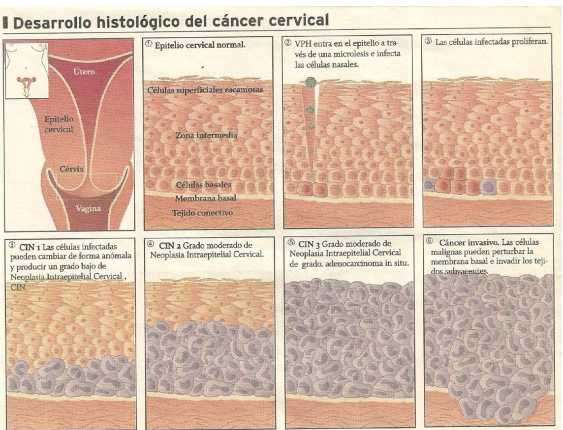 Desarrollo histológico del cáncer cervical